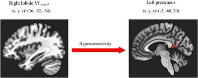 Aberrant Resting-State Cerebellar-Cerebral Functional Connectivity in Unmedicated Patients With Obsessive-Compulsive Disorder